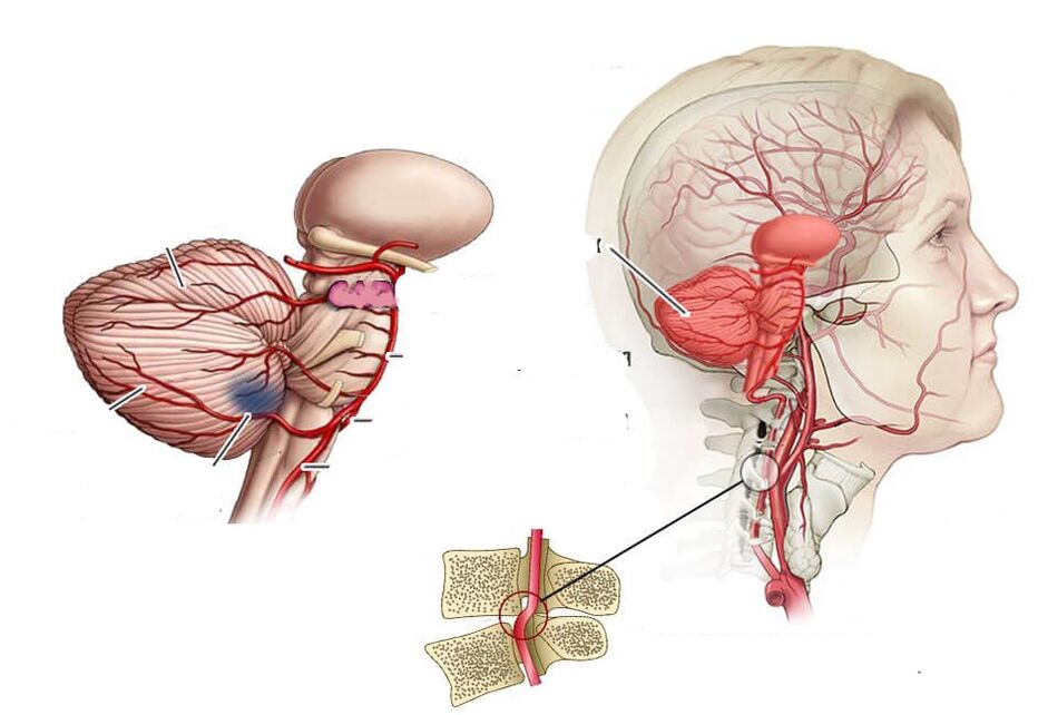 Iskemia cerebellar